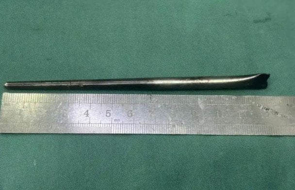 Хагалгаанаас айсан эр 12 см урт төмөр савааг хоолойдоо 8 жил тээжээ 6 Хагалгаанаас айсан эр 12 см урт төмөр савааг хоолойдоо 8 жил тээжээ