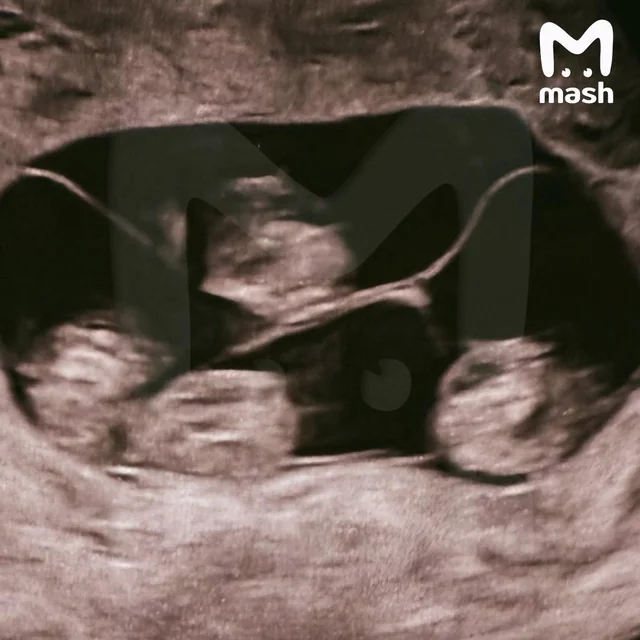 Орост анх удаа нэг өндгөн эсийн дөрвөн ихэр охин мэндэллээ 7 Орост анх удаа нэг өндгөн эсийн дөрвөн ихэр охин мэндэллээ