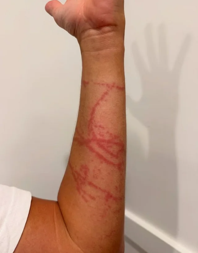 Дэлхийн хамгийн хортой медузэд хатгуулсан сөрфер үхэлтэй нүүр тулжээ 6 Дэлхийн хамгийн хортой медузэд хатгуулсан сөрфер үхэлтэй нүүр тулжээ